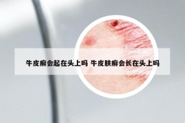 牛皮癣会起在头上吗 牛皮肤癣会长在头上吗