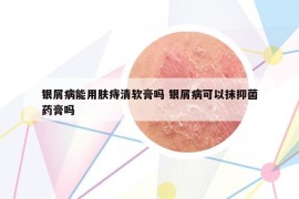 银屑病能用肤痔清软膏吗 银屑病可以抹抑菌药膏吗