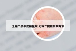 无锡二泉牛皮癣医院 无锡二院银屑病专家