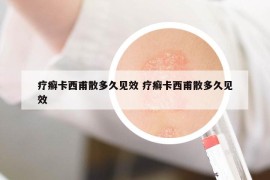 疗癣卡西甫散多久见效 疗癣卡西甫散多久见效