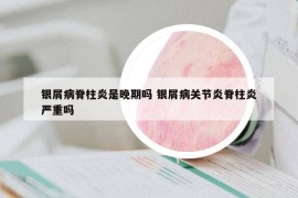 银屑病脊柱炎是晚期吗 银屑病关节炎脊柱炎严重吗