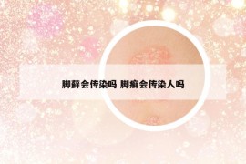 脚藓会传染吗 脚癣会传染人吗