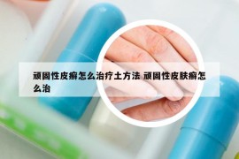 顽固性皮癣怎么治疗土方法 顽固性皮肤癣怎么治