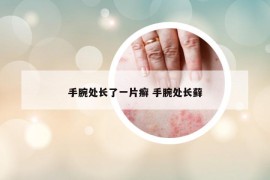 手腕处长了一片癣 手腕处长藓