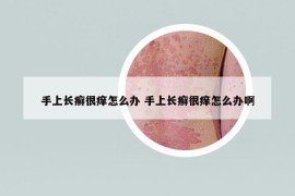 手上长癣很痒怎么办 手上长癣很痒怎么办啊