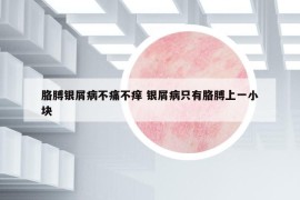 胳膊银屑病不痛不痒 银屑病只有胳膊上一小块