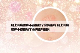 腿上有癣很痒小孩接触了会传染吗 腿上有癣很痒小孩接触了会传染吗图片