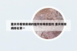 重庆市看银屑病的医院有哪些医院 重庆银屑病排名第一