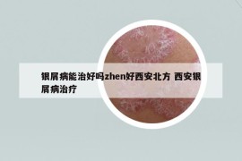 银屑病能治好吗zhen好西安北方 西安银屑病治疗