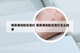 银屑病洗脸后变红 银屑病洗脸后变红怎么回事