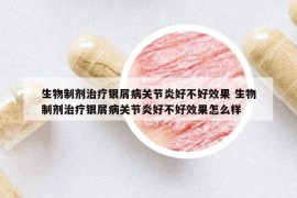 生物制剂治疗银屑病关节炎好不好效果 生物制剂治疗银屑病关节炎好不好效果怎么样