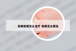 皮癣皮癣怎么治疗 皮癣怎么根治