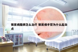 银屑病胳膊怎么治疗 银屑病手臂为什么起白点