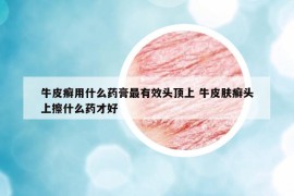 牛皮癣用什么药膏最有效头顶上 牛皮肤癣头上擦什么药才好