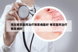 现在那家医院治疗银屑病最好 哪家医院治疗银屑病好