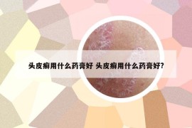 头皮癣用什么药膏好 头皮癣用什么药膏好?