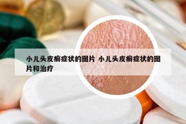 小儿头皮癣症状的图片 小儿头皮癣症状的图片和治疗