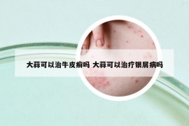 大蒜可以治牛皮癣吗 大蒜可以治疗银屑病吗