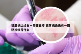 银屑病边缘有一圈硬丘疹 银屑病边缘有一圈硬丘疹是什么