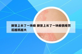 脚背上长了一块癣 脚背上长了一块癣很痒然后越抓越大