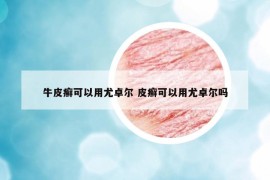 牛皮癣可以用尤卓尔 皮癣可以用尤卓尔吗