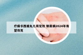 疗癣卡西甫丸几周见效 银屑病2024年有望攻克