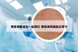 银屑病都连在一起很红 银屑病周围起红疹子