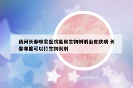 请问长春哪家医院能用生物制剂治皮肤病 长春哪里可以打生物制剂