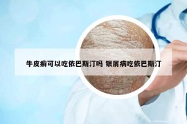 牛皮癣可以吃依巴斯汀吗 银屑病吃依巴斯汀