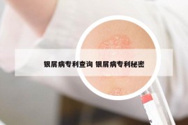 银屑病专利查询 银屑病专利秘密