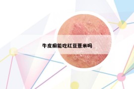 牛皮癣能吃红豆薏米吗