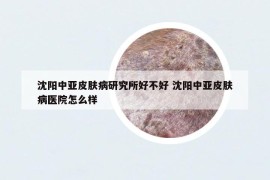 沈阳中亚皮肤病研究所好不好 沈阳中亚皮肤病医院怎么样