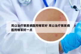 周口治疗银屑病医院哪家好 周口治疗银屑病医院哪家好一点