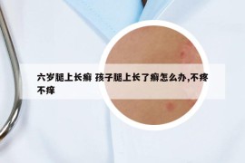 六岁腿上长癣 孩子腿上长了癣怎么办,不疼不痒