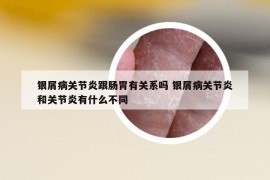 银屑病关节炎跟肠胃有关系吗 银屑病关节炎和关节炎有什么不同