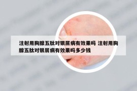 注射用胸腺五肽对银屑病有效果吗 注射用胸腺五肽对银屑病有效果吗多少钱