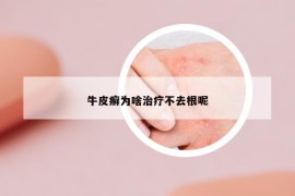 牛皮癣为啥治疗不去根呢