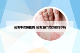 延吉牛皮癣医院 延吉治疗皮肤病的诊所