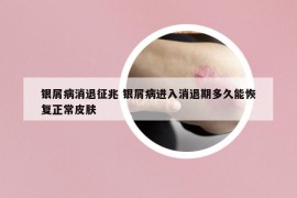 银屑病消退征兆 银屑病进入消退期多久能恢复正常皮肤