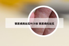 银屑病用丝瓜叶汁抹 银屑病吃丝瓜