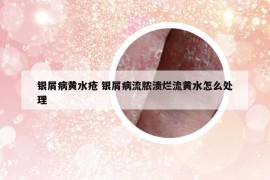 银屑病黄水疮 银屑病流脓溃烂流黄水怎么处理