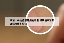 窄波UVB治疗银屑病的效果 银屑病窄波紫外线治疗多少钱