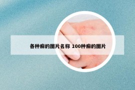 各种癣的图片名称 100种癣的图片