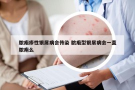 脓疱疹性银屑病会传染 脓疱型银屑病会一直脓疱么