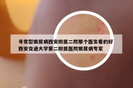 寻常型银屑病西安附属二院那个医生看的好 西安交通大学第二附属医院银屑病专家