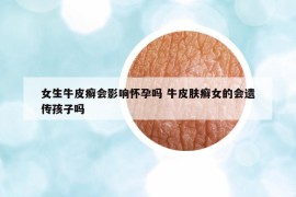 女生牛皮癣会影响怀孕吗 牛皮肤癣女的会遗传孩子吗