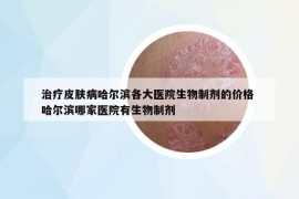 治疗皮肤病哈尔滨各大医院生物制剂的价格 哈尔滨哪家医院有生物制剂