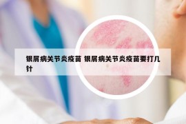 银屑病关节炎疫苗 银屑病关节炎疫苗要打几针