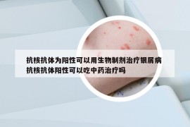 抗核抗体为阳性可以用生物制剂治疗银屑病 抗核抗体阳性可以吃中药治疗吗