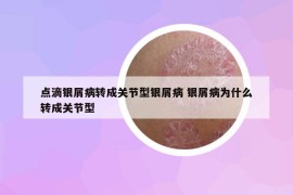 点滴银屑病转成关节型银屑病 银屑病为什么转成关节型